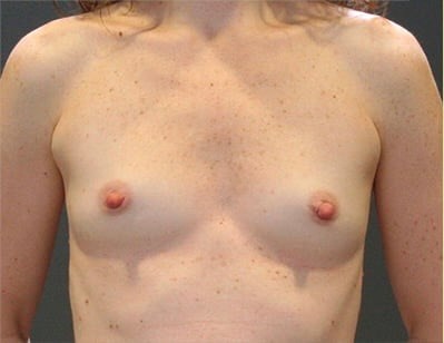 Before Image: San Diego Woman Receives Breast Augmentation - front