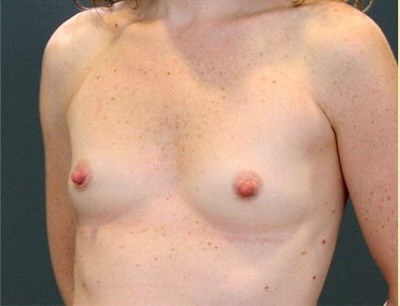 Before Image: San Diego Woman Receives Breast Augmentation - left-front-oblique