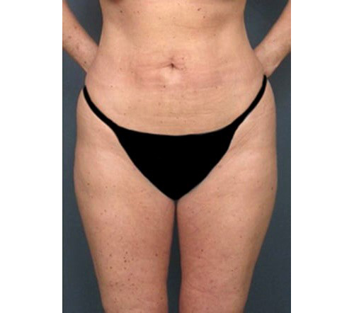 After Image: San Diego Patient Receives Body Contouring, Liposuction - front