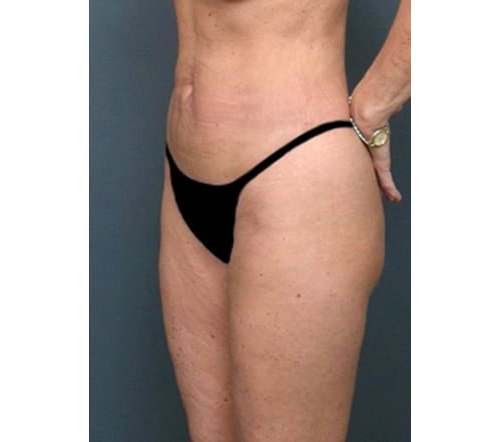 After Image: San Diego Patient Receives Body Contouring, Liposuction - left-front-oblique
