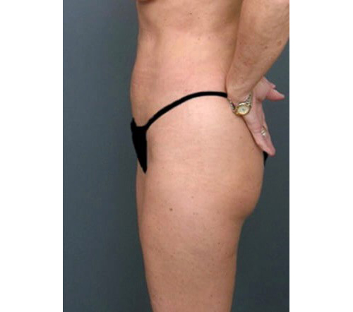 After Image: San Diego Patient Receives Body Contouring, Liposuction - left-side
