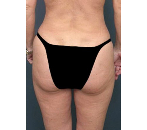 After Image: San Diego Patient Receives Body Contouring, Liposuction - back