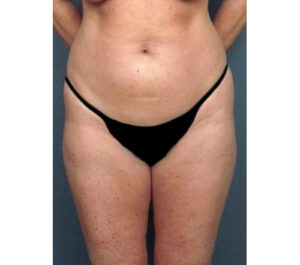 Before Image: San Diego Patient Receives Body Contouring, Liposuction