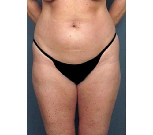 Before Image: San Diego Patient Receives Body Contouring, Liposuction - front