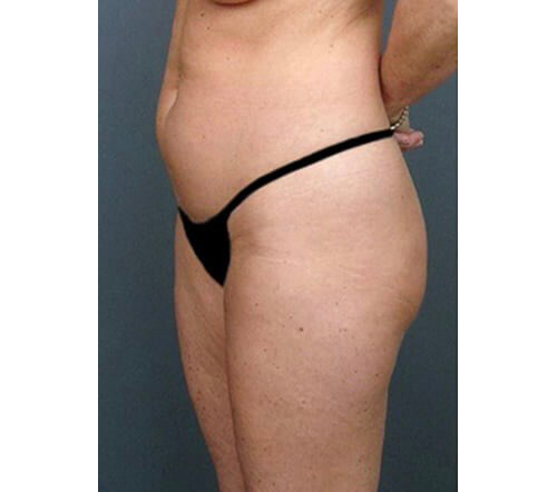 Before Image: San Diego Patient Receives Body Contouring, Liposuction - left-front-oblique