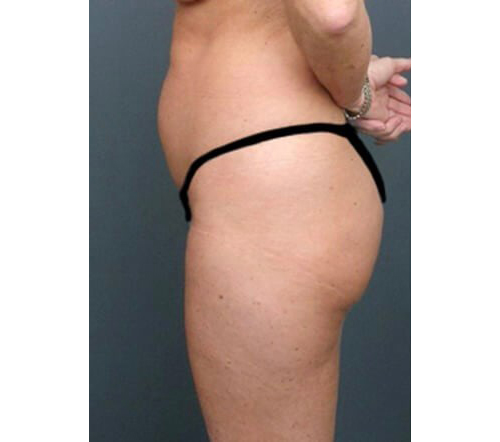 Before Image: San Diego Patient Receives Body Contouring, Liposuction - left-side