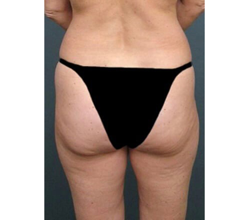 Before Image: San Diego Patient Receives Body Contouring, Liposuction - back