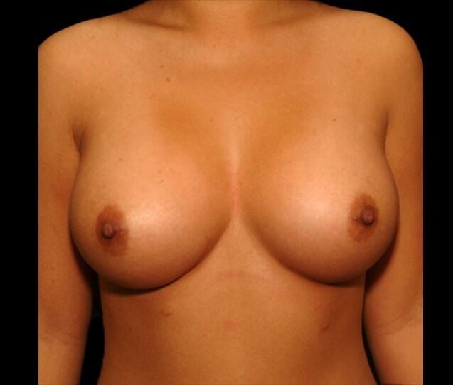After Image: San Diego Patient Receives Breast Augmentation - front