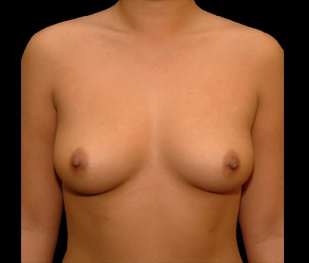 Before Image: San Diego Patient Receives Breast Augmentation - front
