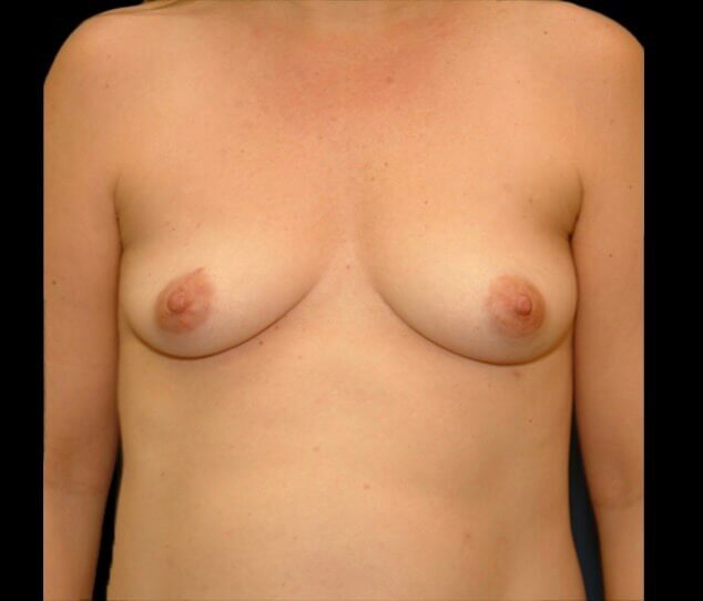 Before Image: San Diego, CA Patient Receives Breast Augmentation - front