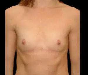 Before Image: San Diego Patient Undergoes Breast Augmentation