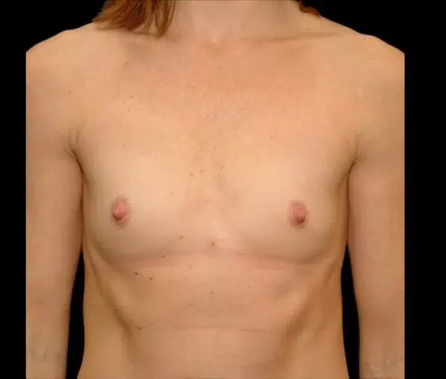 Before Image: San Diego Patient Undergoes Breast Augmentation - front