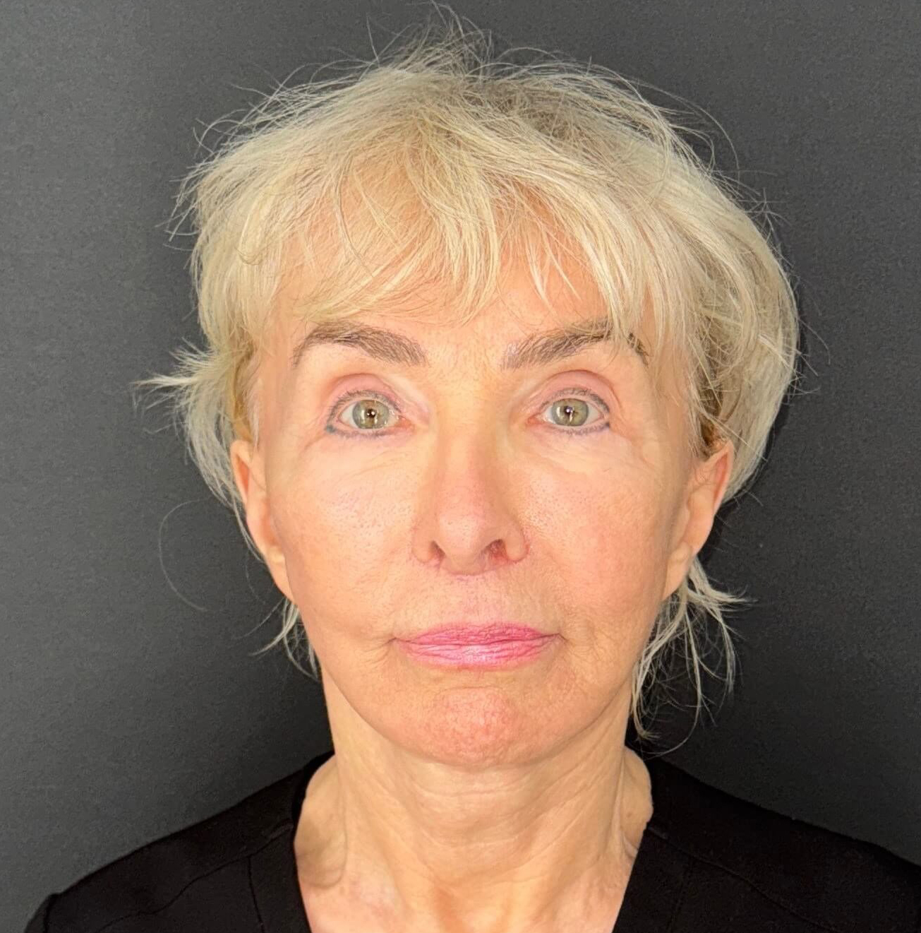 After Image: 72-Year-Old Woman: Facelift, Necklift, Lip Lift & Fat Transfer Rejuvenation - front