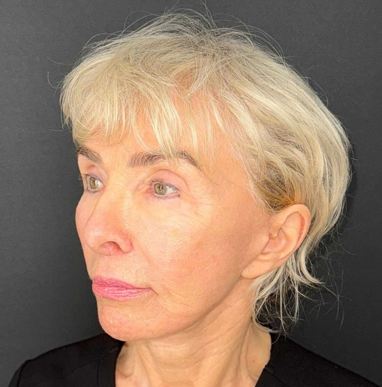 After Image: 72-Year-Old Woman: Facelift, Necklift, Lip Lift & Fat Transfer Rejuvenation - left-front-oblique