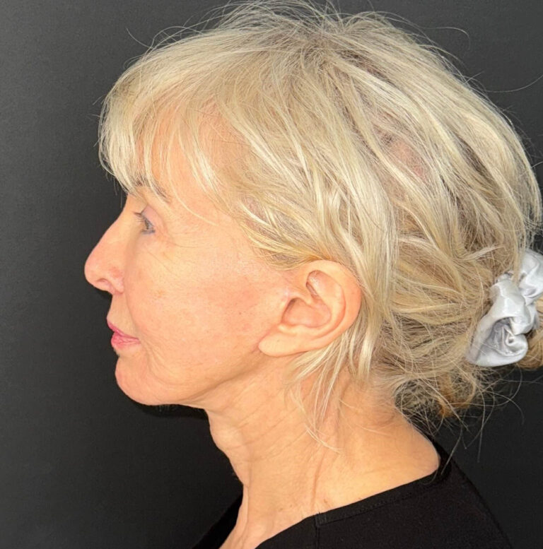 After Image: 72-Year-Old Woman: Facelift, Necklift, Lip Lift & Fat Transfer Rejuvenation - left-side