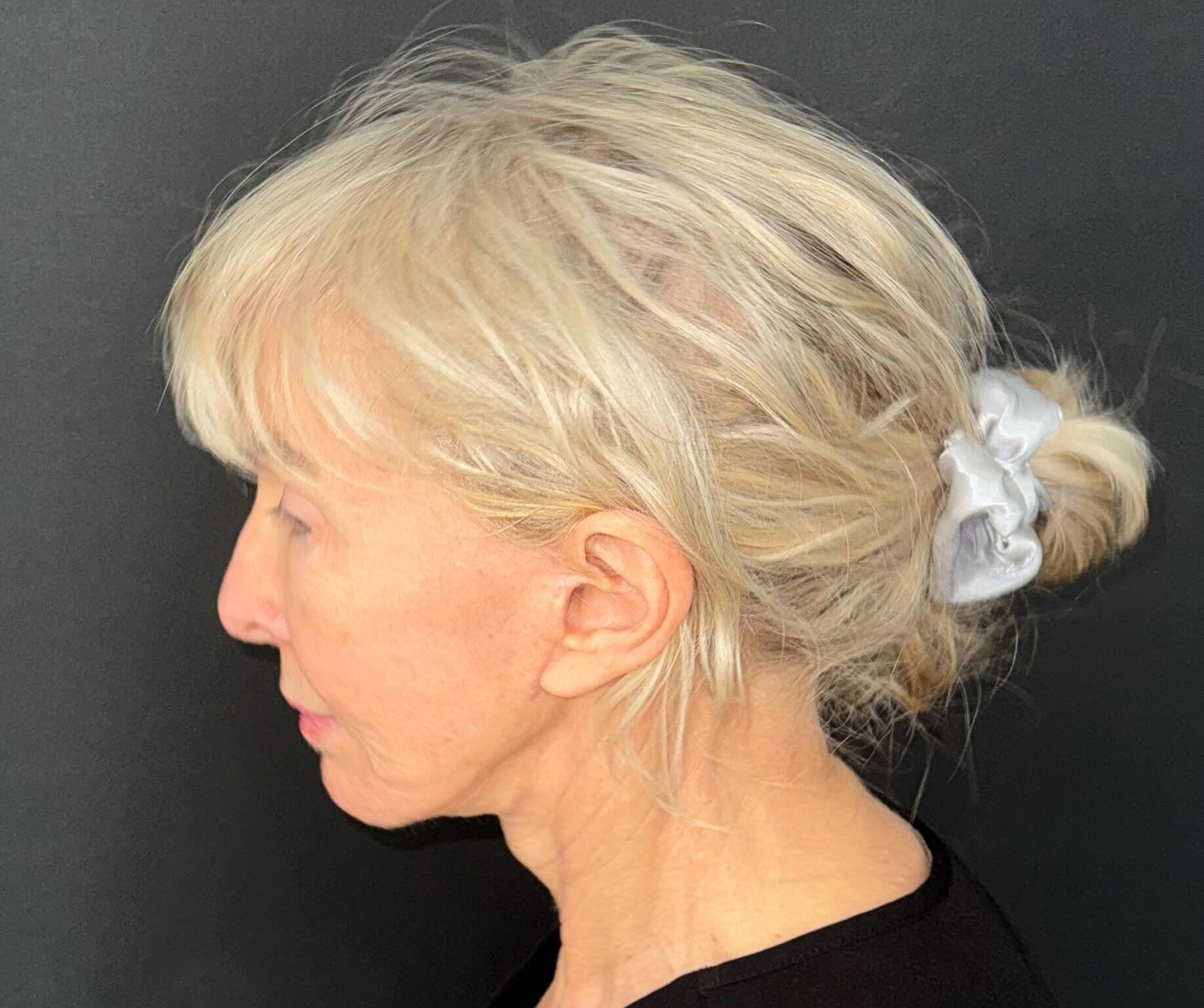 After Image: 72-Year-Old Woman: Facelift, Necklift, Lip Lift & Fat Transfer Rejuvenation - left-side