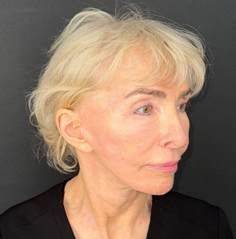After Image: 72-Year-Old Woman: Facelift, Necklift, Lip Lift & Fat Transfer Rejuvenation - right-front-oblique