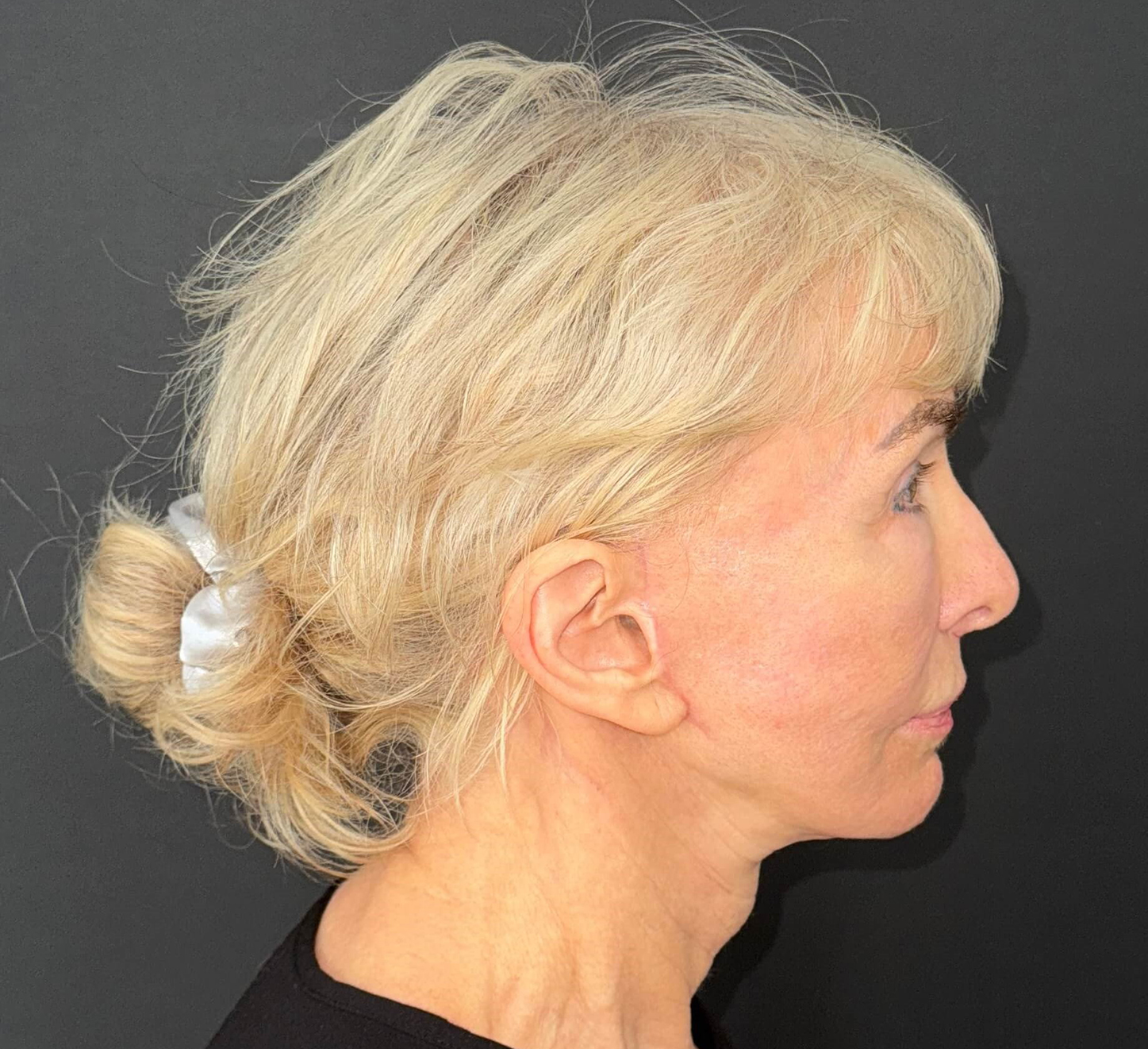 After Image: 72-Year-Old Woman: Facelift, Necklift, Lip Lift & Fat Transfer Rejuvenation - right-side