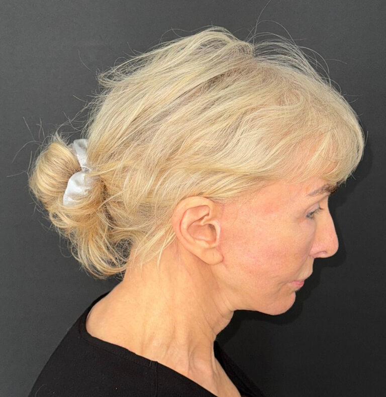 After Image: 72-Year-Old Woman: Facelift, Necklift, Lip Lift & Fat Transfer Rejuvenation - right-side