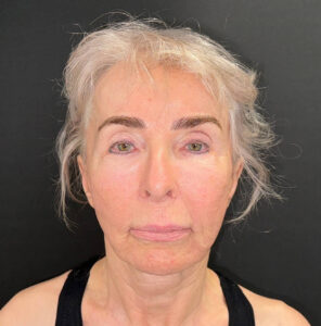 Before Image: 72-Year-Old Woman: Facelift, Necklift, Lip Lift & Fat Transfer Rejuvenation