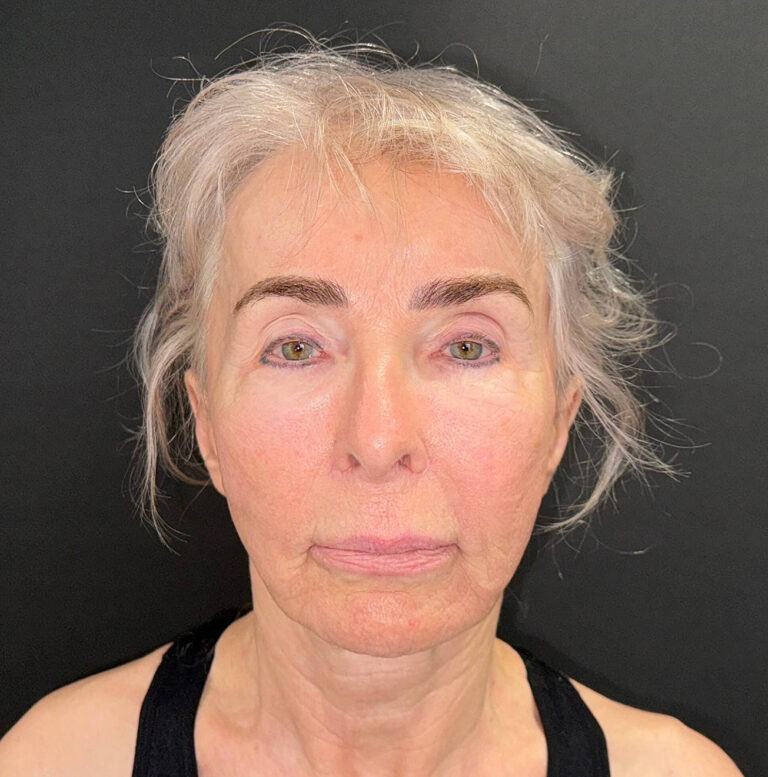 Before Image: 72-Year-Old Woman: Facelift, Necklift, Lip Lift & Fat Transfer Rejuvenation - front