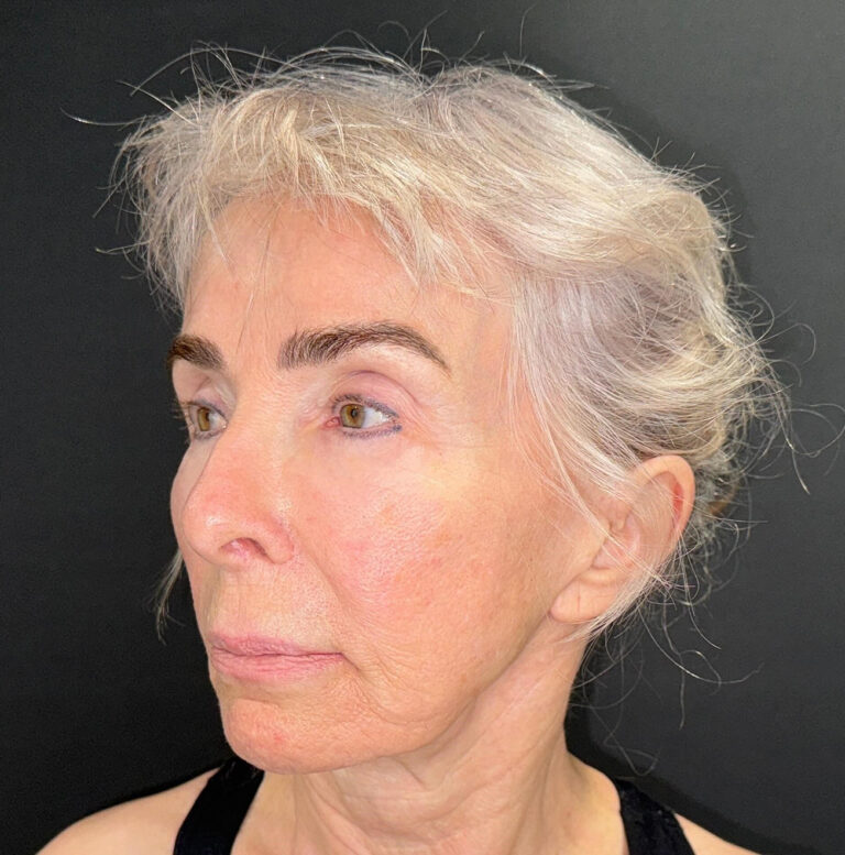 Before Image: 72-Year-Old Woman: Facelift, Necklift, Lip Lift & Fat Transfer Rejuvenation - left-front-oblique