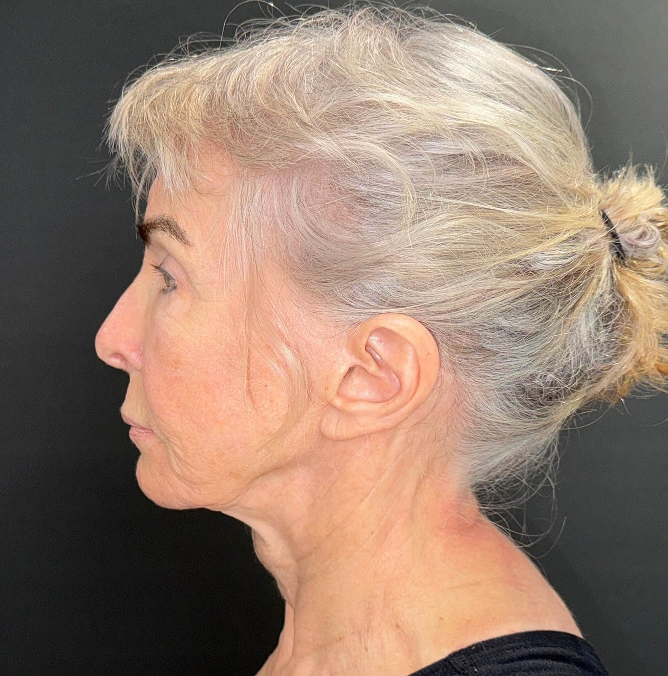 Before Image: 72-Year-Old Woman: Facelift, Necklift, Lip Lift & Fat Transfer Rejuvenation - left-side