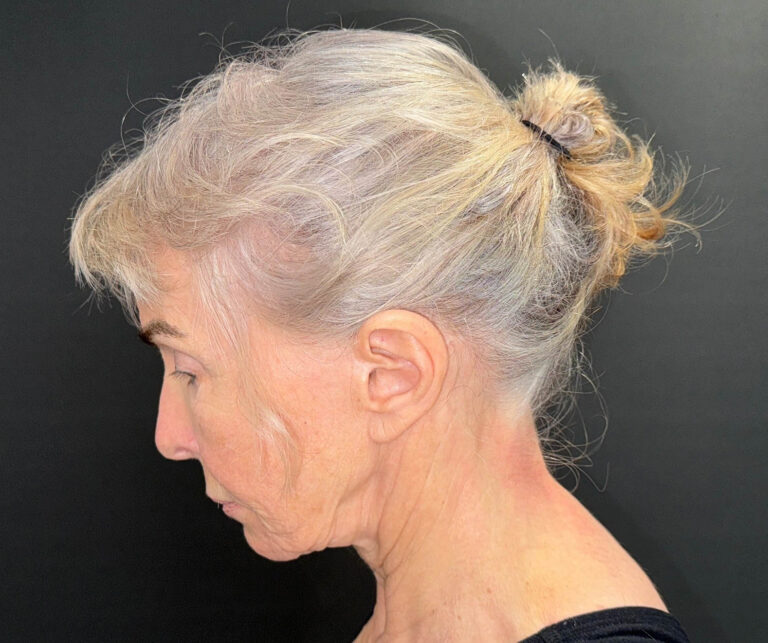 Before Image: 72-Year-Old Woman: Facelift, Necklift, Lip Lift & Fat Transfer Rejuvenation - left-side