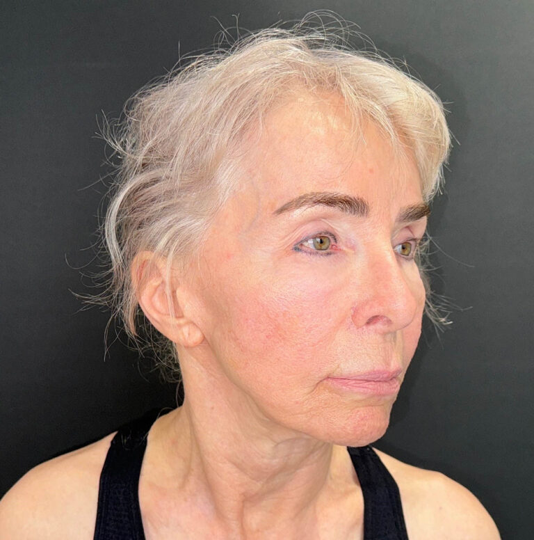 Before Image: 72-Year-Old Woman: Facelift, Necklift, Lip Lift & Fat Transfer Rejuvenation - right-front-oblique
