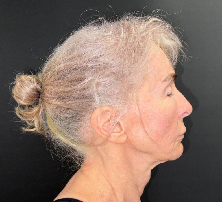 Before Image: 72-Year-Old Woman: Facelift, Necklift, Lip Lift & Fat Transfer Rejuvenation - right-side