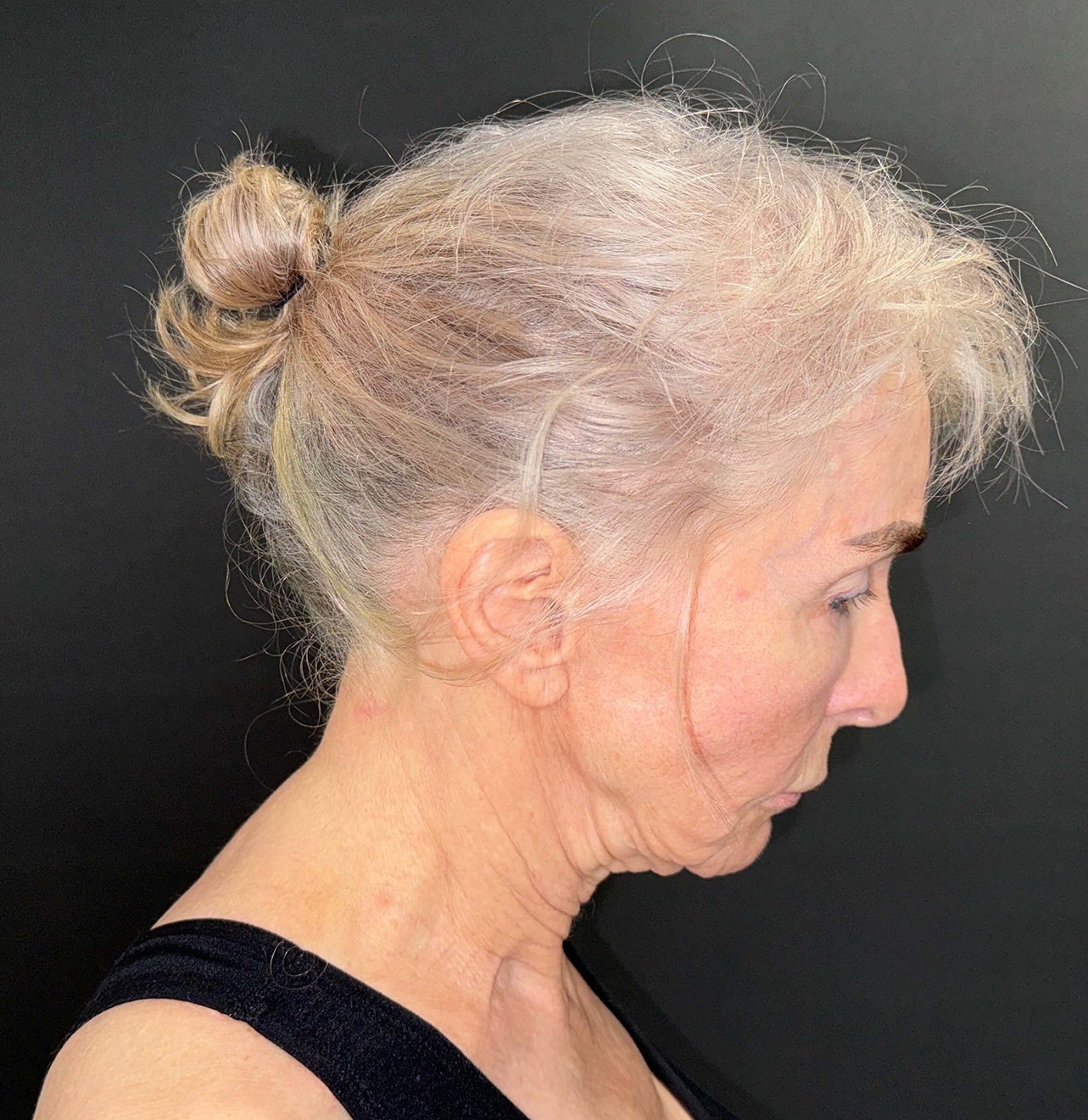 Before Image: 72-Year-Old Woman: Facelift, Necklift, Lip Lift & Fat Transfer Rejuvenation - right-side