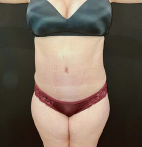 After Image: San Diego Patient Undergoes Tummy Tuck