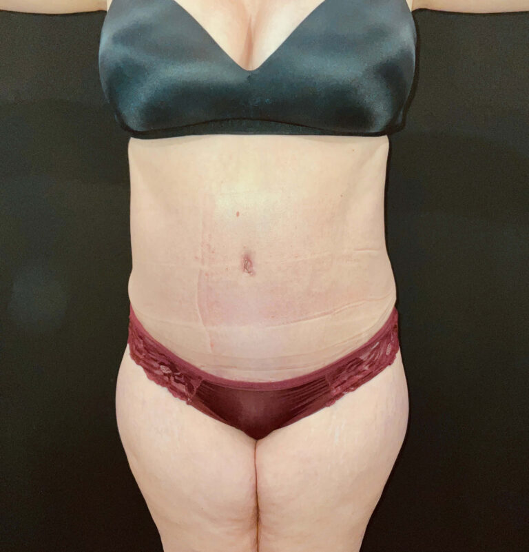 After Image: San Diego Patient Undergoes Tummy Tuck -