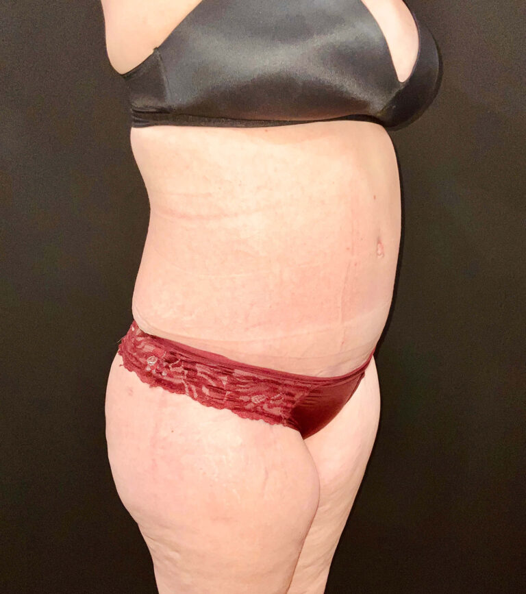 After Image: San Diego Patient Undergoes Tummy Tuck - right-front-oblique