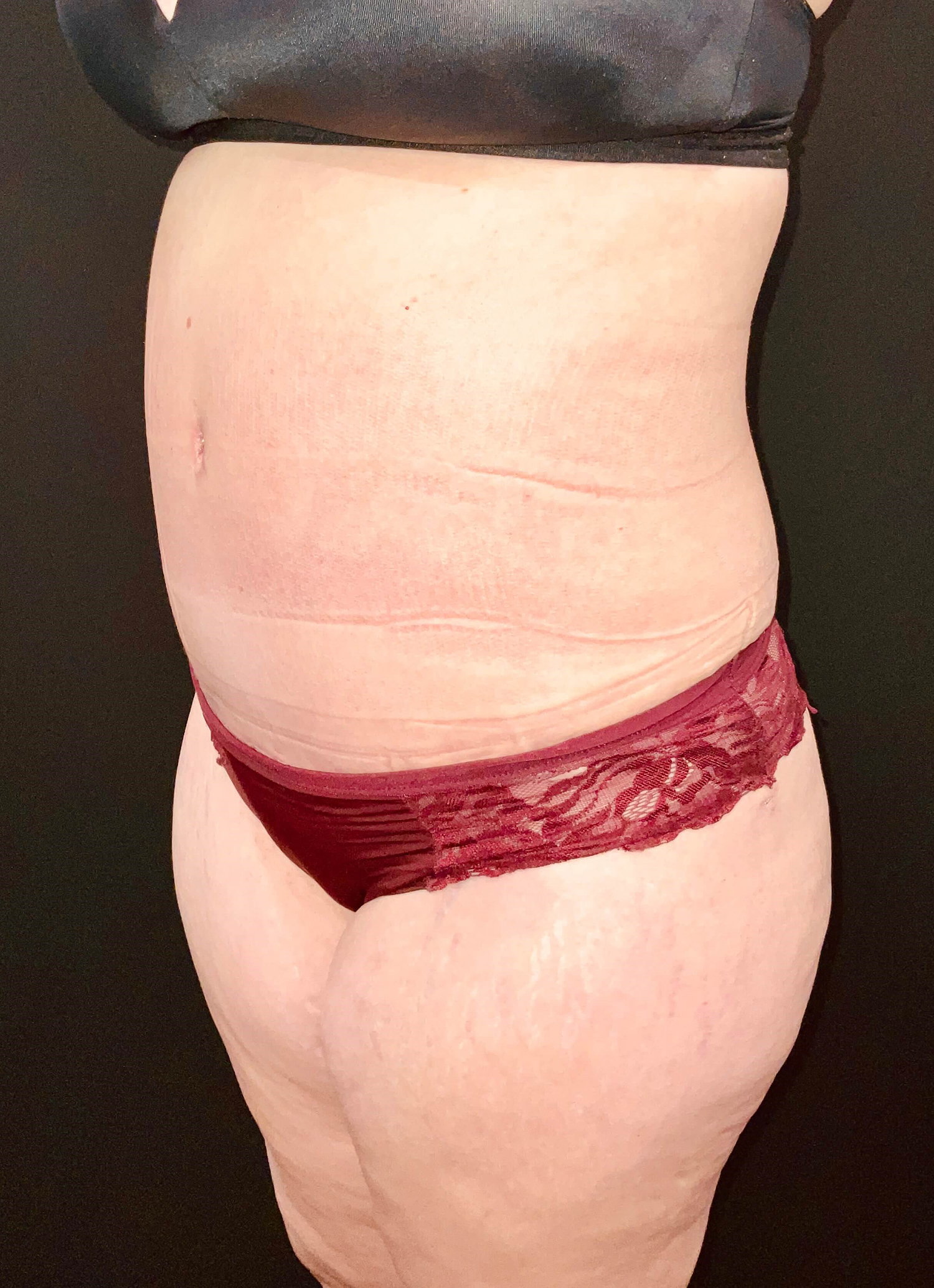 After Image: San Diego Patient Undergoes Tummy Tuck - left-front-oblique