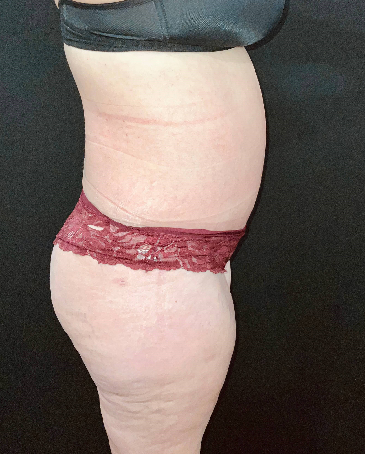 After Image: San Diego Patient Undergoes Tummy Tuck - right-side