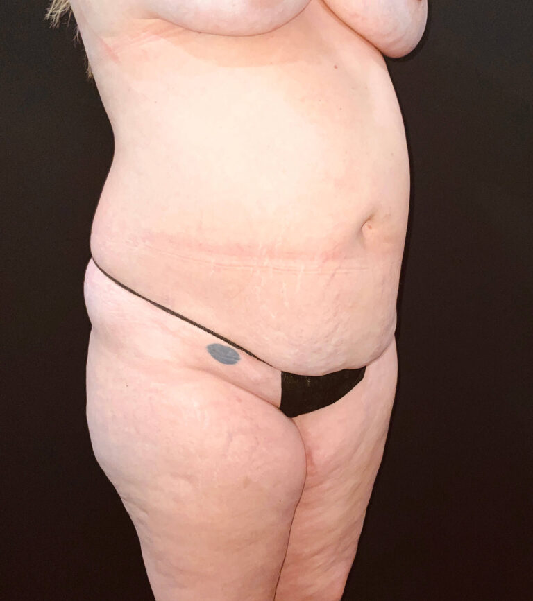 Before Image: San Diego Patient Undergoes Tummy Tuck - right-front-oblique
