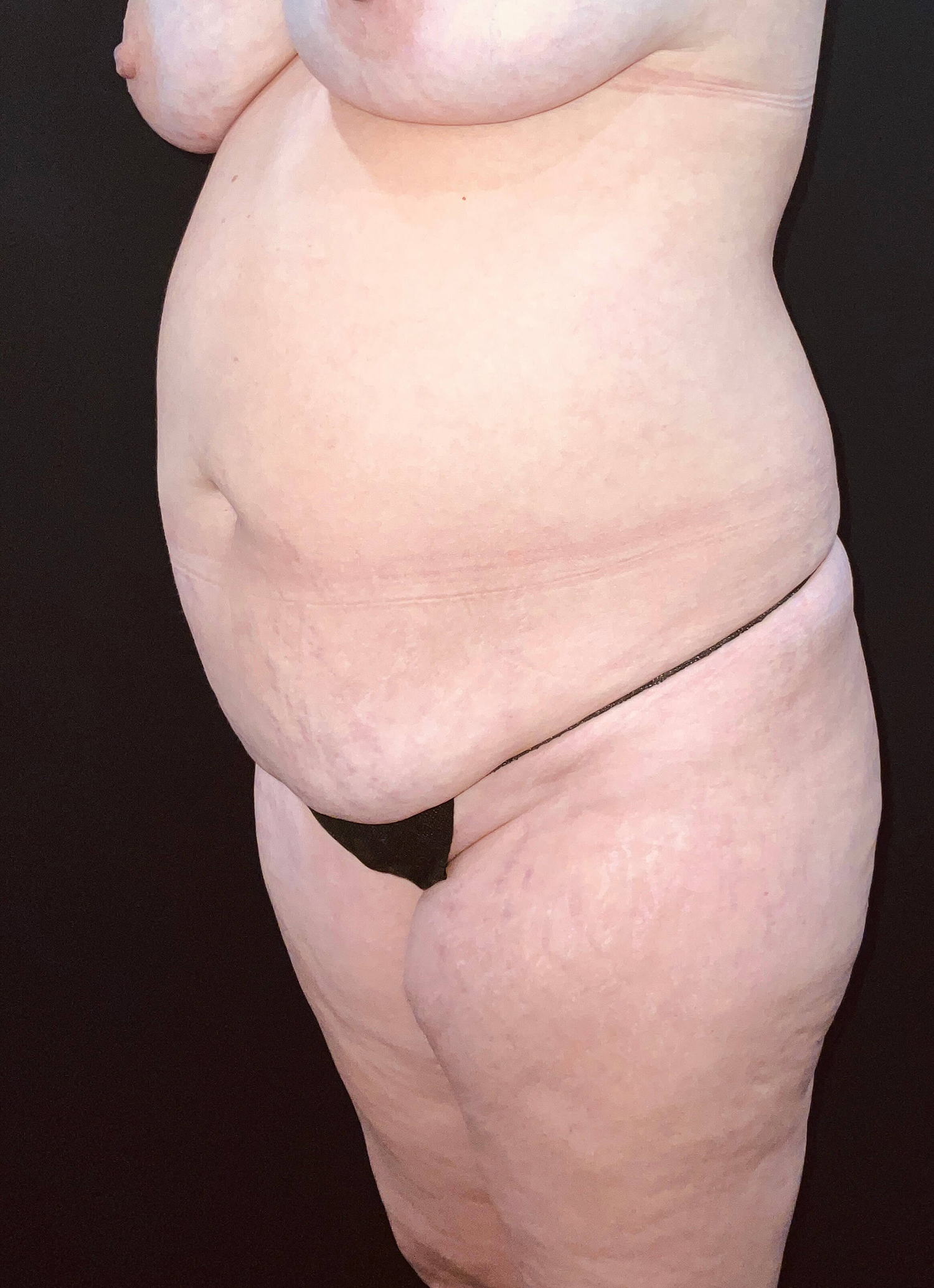 Before Image: San Diego Patient Undergoes Tummy Tuck - left-front-oblique