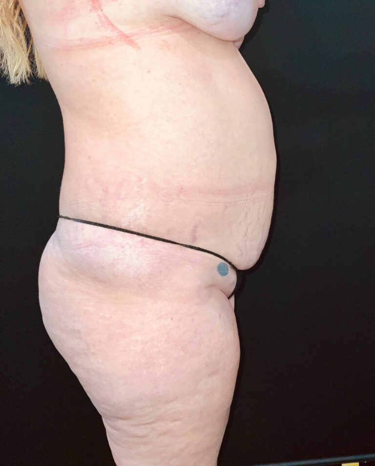 Before Image: San Diego Patient Undergoes Tummy Tuck - right-side