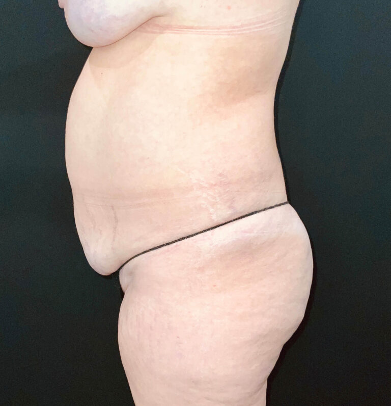 Before Image: San Diego Patient Undergoes Tummy Tuck - left-side