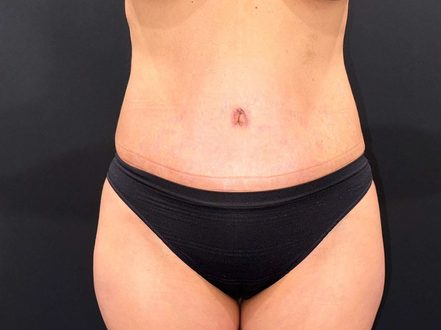 After Image: Patient in San Diego, CA Undergoes Successful Tummy Tuck Procedure - front