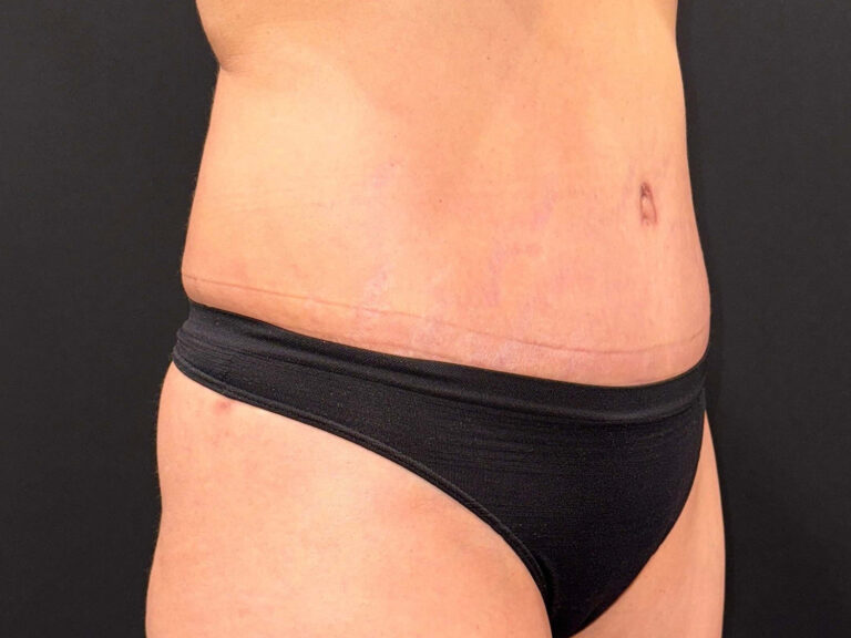After Image: Patient in San Diego, CA Undergoes Successful Tummy Tuck Procedure - right-front-oblique