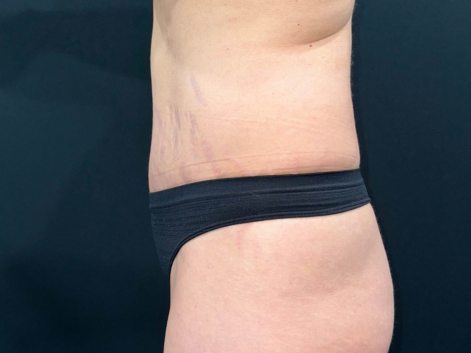 After Image: Patient in San Diego, CA Undergoes Successful Tummy Tuck Procedure - left-side