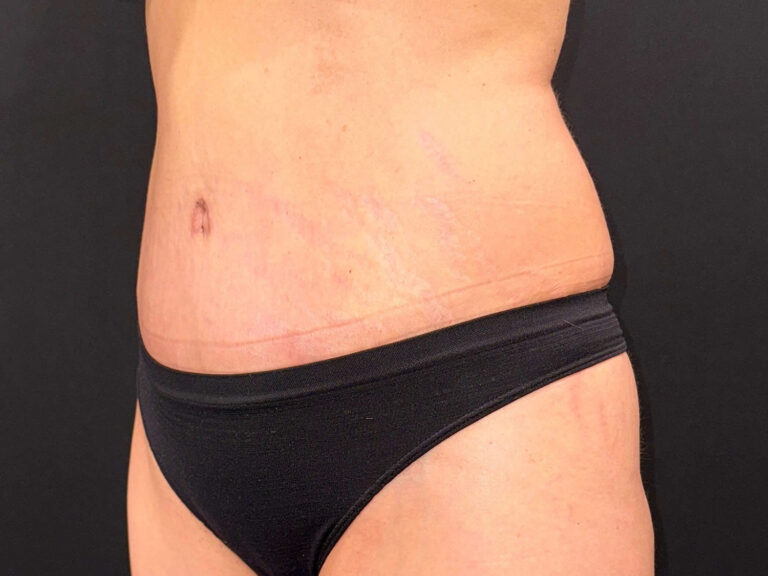 After Image: Patient in San Diego, CA Undergoes Successful Tummy Tuck Procedure - left-front-oblique