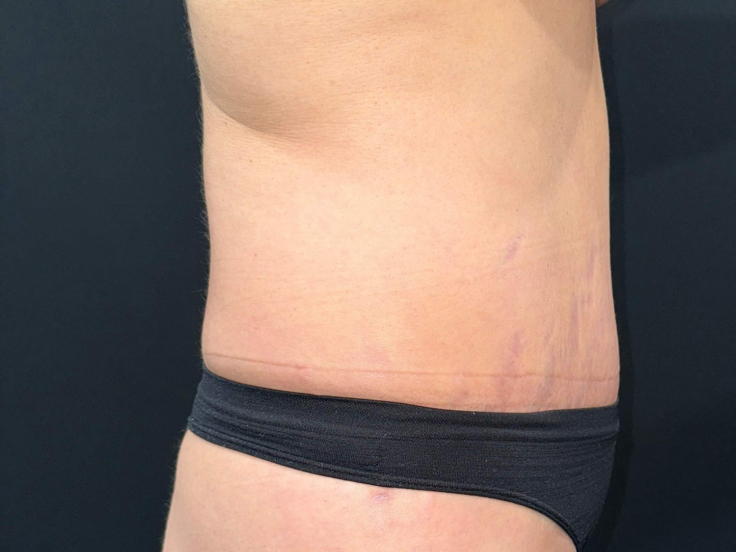 After Image: Patient in San Diego, CA Undergoes Successful Tummy Tuck Procedure - right-side