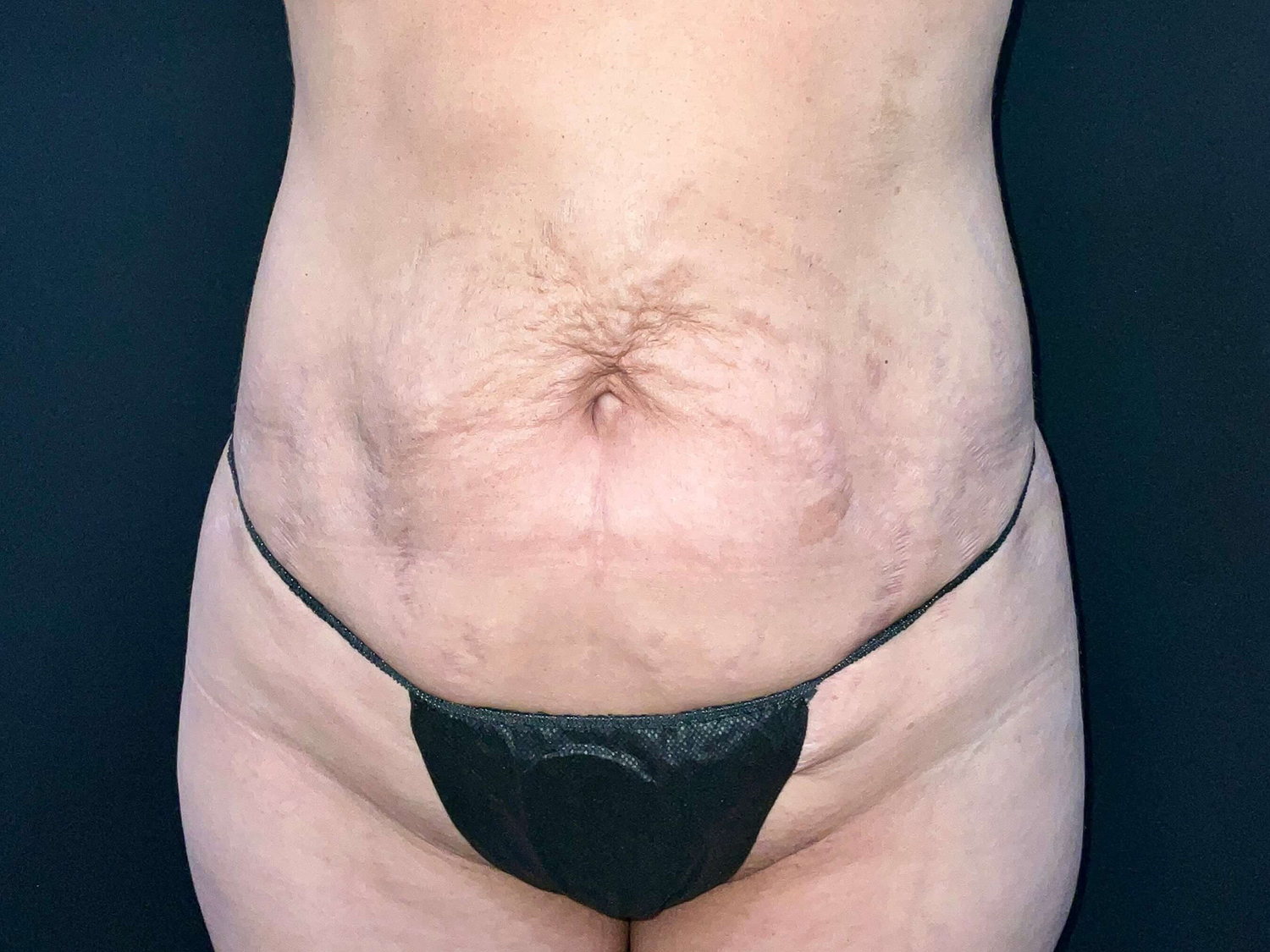 Before Image: Patient in San Diego, CA Undergoes Successful Tummy Tuck Procedure - front