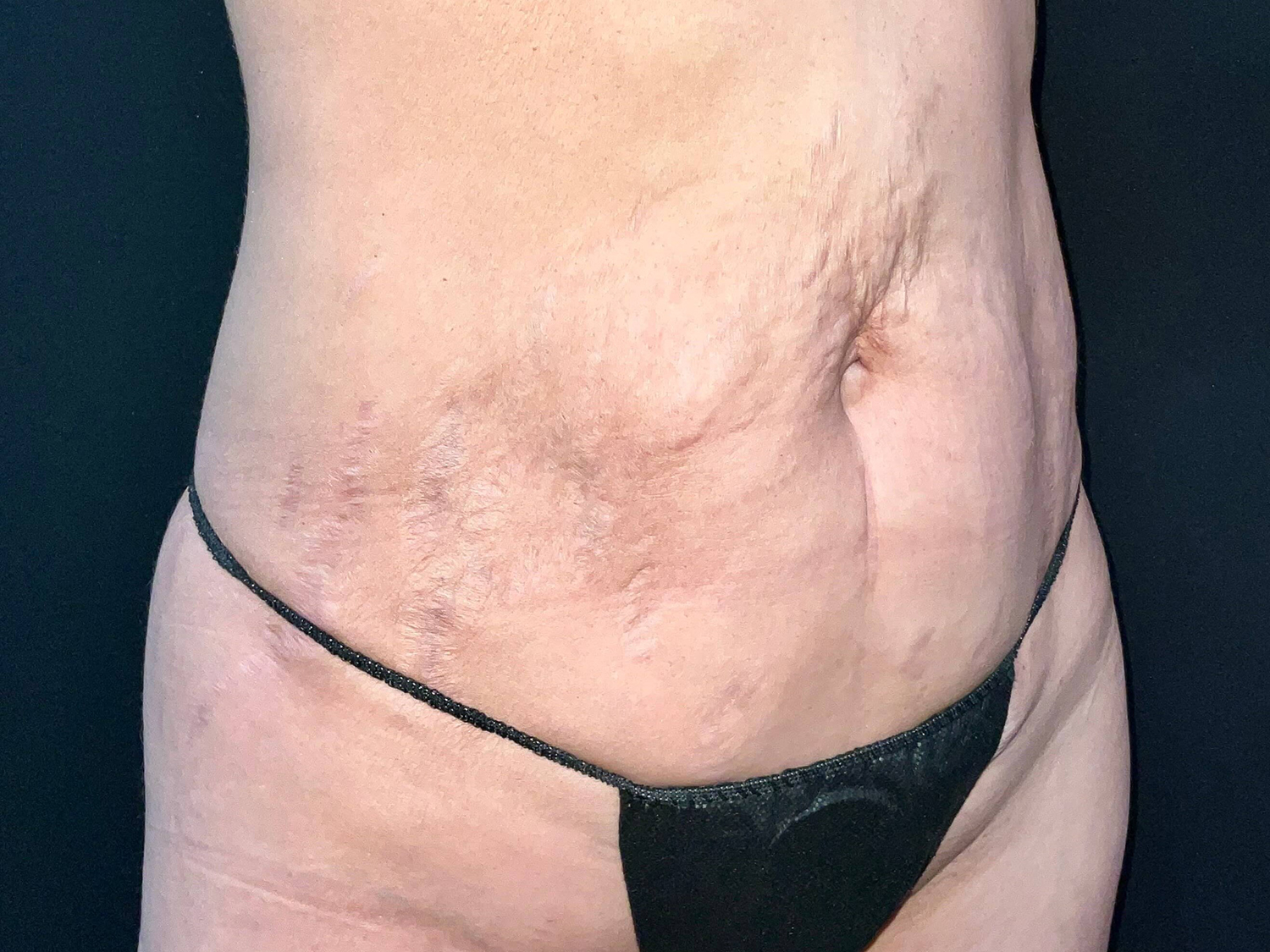 Before Image: Patient in San Diego, CA Undergoes Successful Tummy Tuck Procedure - right-front-oblique