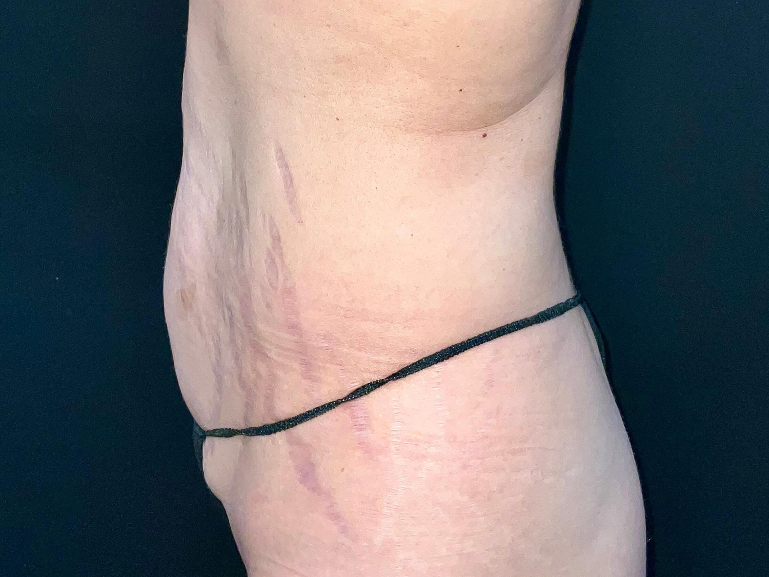 Before Image: Patient in San Diego, CA Undergoes Successful Tummy Tuck Procedure - left-side