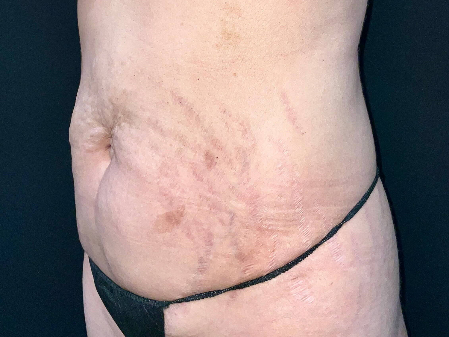 Before Image: Patient in San Diego, CA Undergoes Successful Tummy Tuck Procedure - left-front-oblique