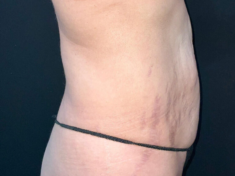 Before Image: Patient in San Diego, CA Undergoes Successful Tummy Tuck Procedure - right-side